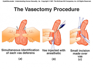 vasectomia-centromedico001